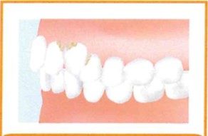 歯並び・歯ぎしりと歯周病