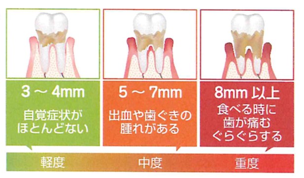 歯周ポケットの基礎知識2
