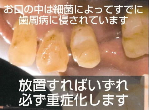 歯周病検査の結果