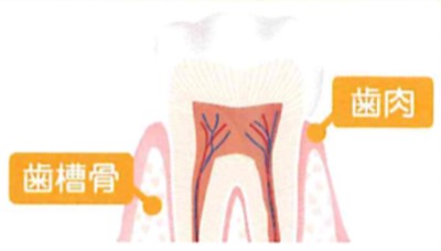 歯肉炎と歯周炎