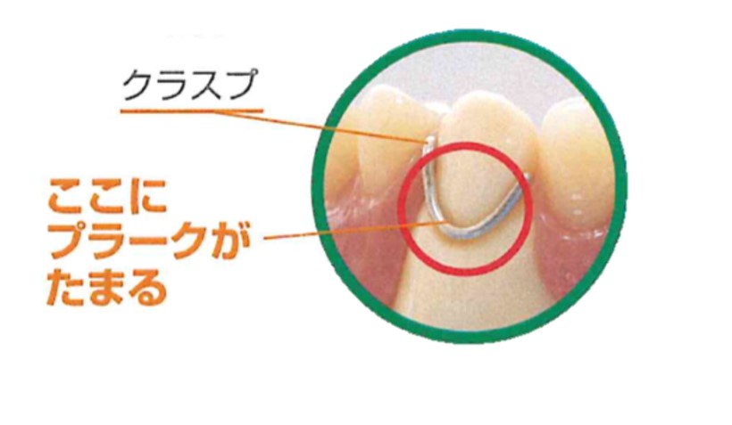 入れ歯によるむし歯・歯周病
